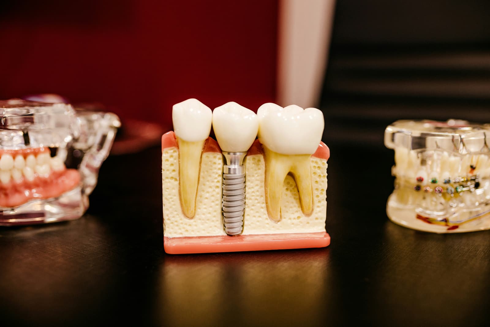 Dental implant model showing titanium post and crown